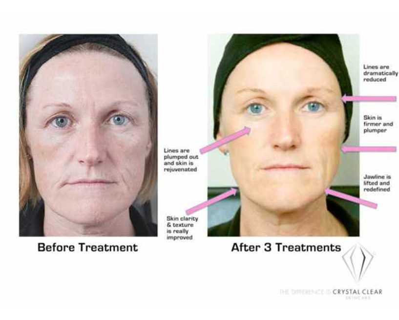 Facial treatment before and after